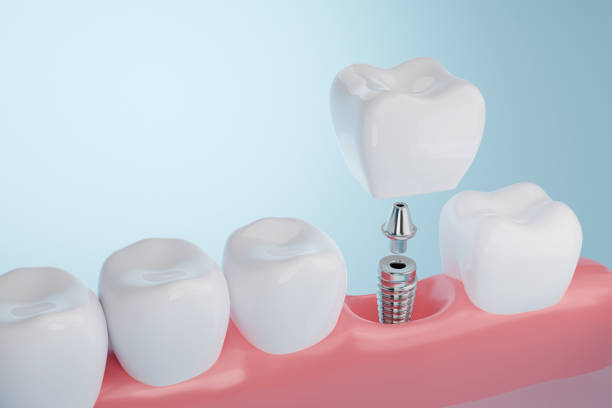 graphic of a dental implant with post in jawbone
